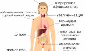 Диффузный токсический зоб
