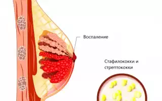 Послеродовой мастит