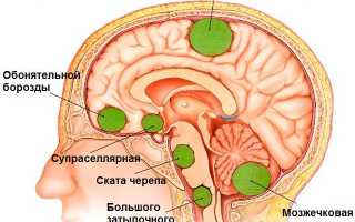 Опухоли головного мозга