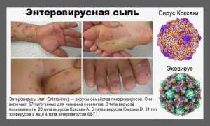 Энтеровирусные инфекции Коксаки и ЭХО у детей