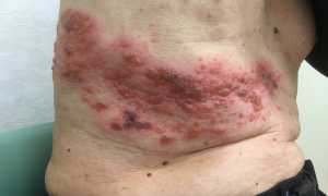 Опоясывающий лишай (Herpes zoster)