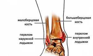 Переломы лодыжек