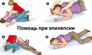 Эпилепсия
