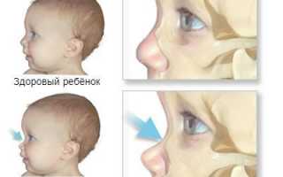 Мукополисахаридозы