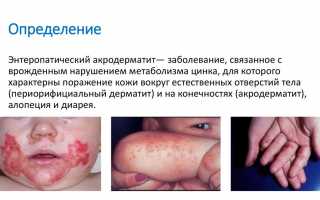 Акродерматит энтеропатический