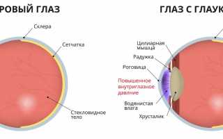Глаукома