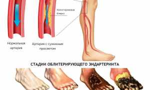 Облитерирующий эндартериит