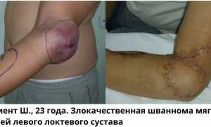Саркомы